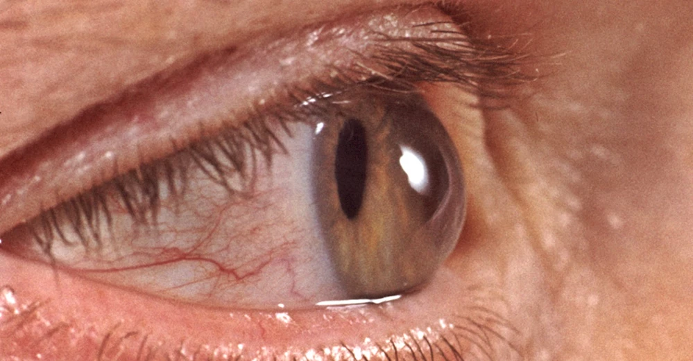 SONBAHARDA GÖZ HASTALIKLARINA DİKKAT!